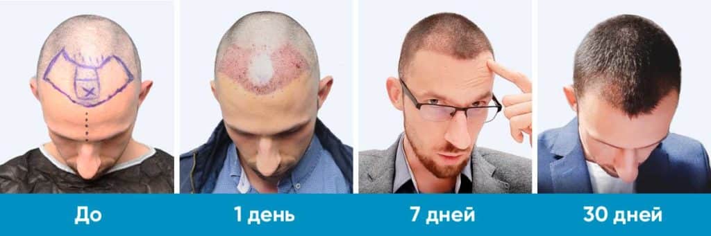 Фото пациента Давида на протяжении 30 дней