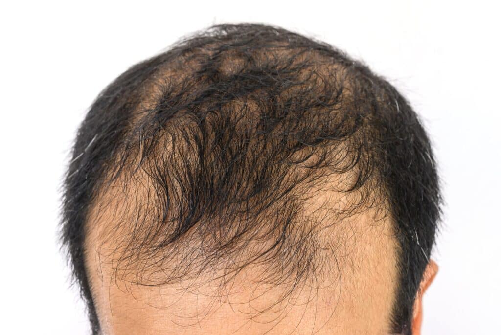 alopecia androgenetica huidziekten