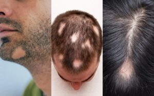 alopecia-areata-cosmedica