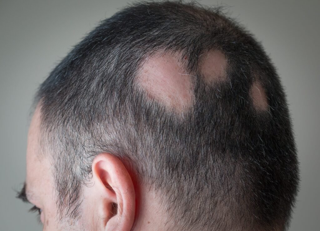 Man with alopecia areata