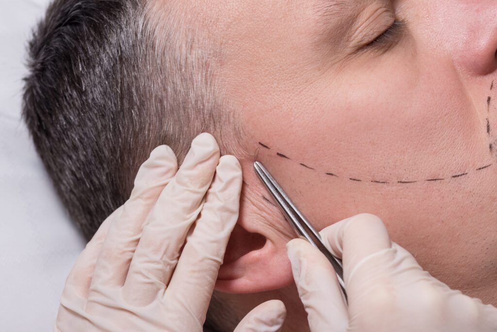 Man being prepared for a beard transplant