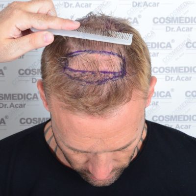 Dr. Acar combing back Calum Best's hair to show the extent of his hair loss on the top of his head