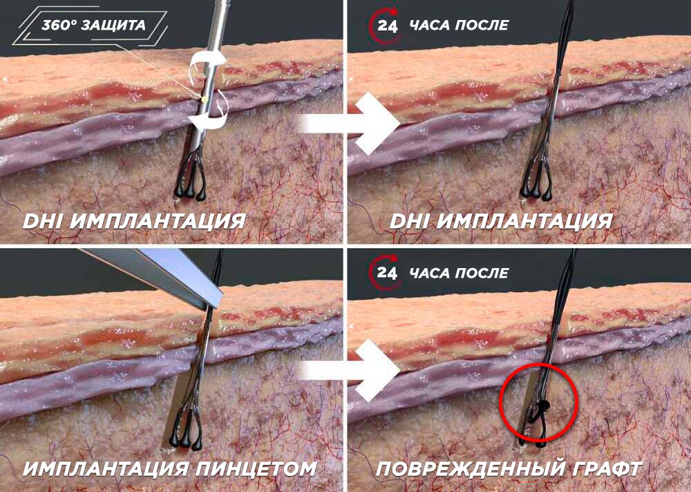 Сравнение методик имплантации