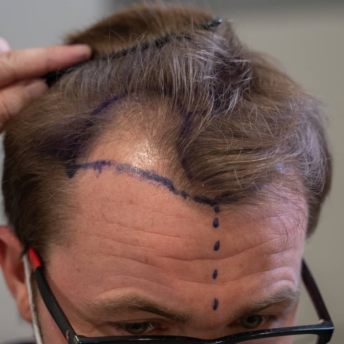 A patient with male pattern baldness