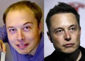 elon-musk-przeszczep-wlosow