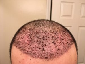 Redness after hair transplant