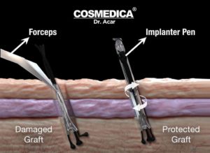 haartransplantatie-turkije-dhi-saffier-implantatie