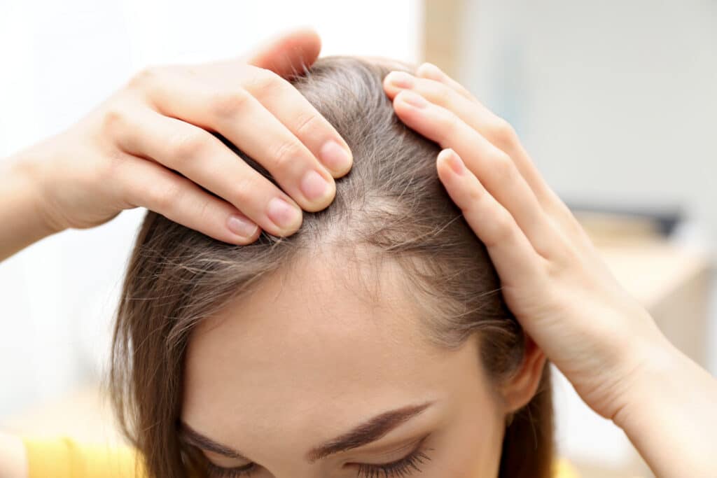 Vrouw met haaruitval