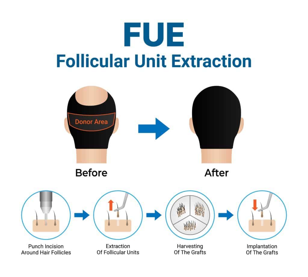 View of a hair transplant donor area in a FUE hair transplant