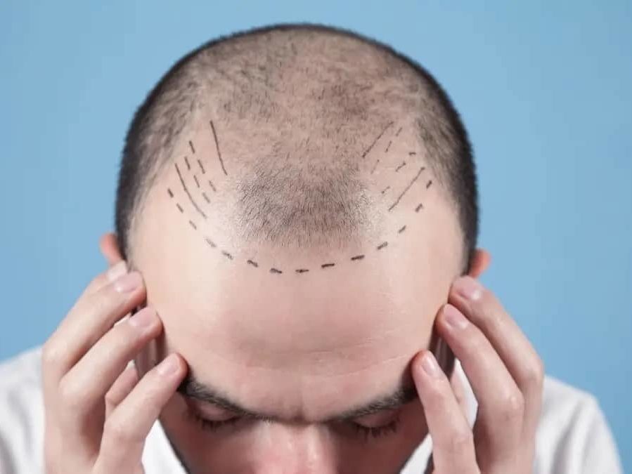 hair transplant pain