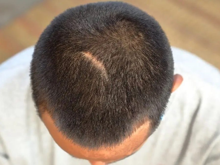 hair transplant scar