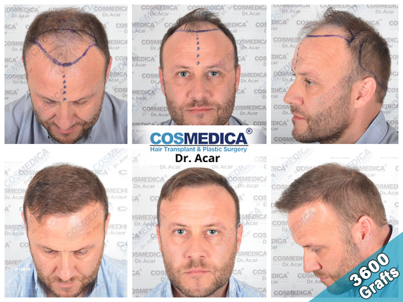 hair transplant turkey result with 3600 grafts