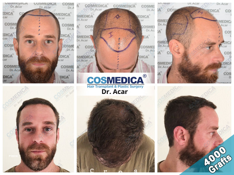 hair transplant turkey result with 4000 grafts