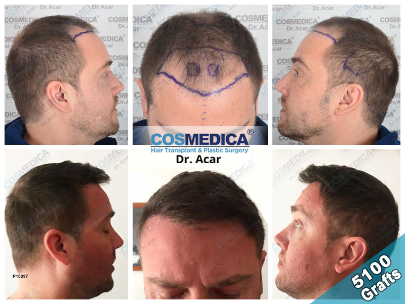 hair transplant turkey result with 5100 grafts