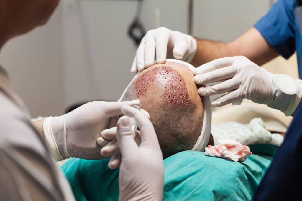 Hair transplantation surgery