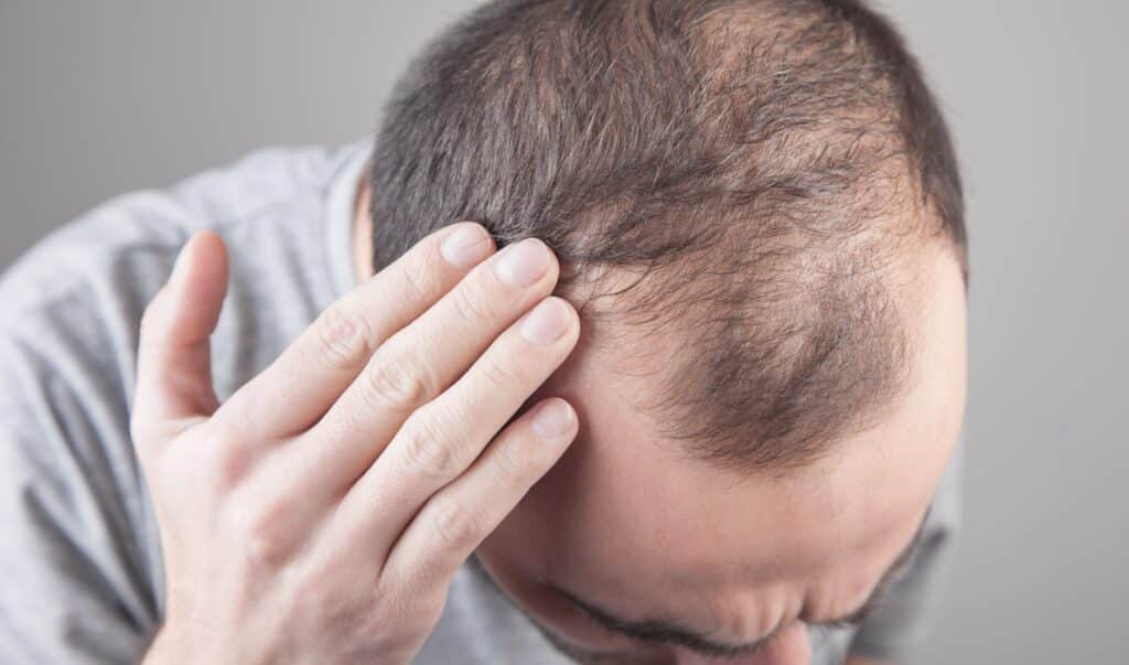 Man losing his hair