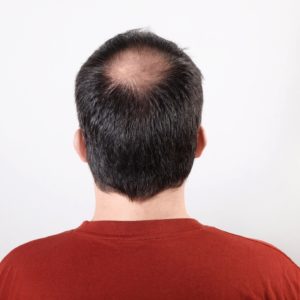 male pattern baldness