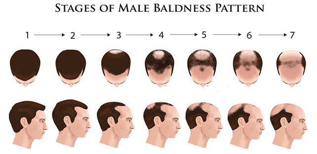Male Patteren Baldness