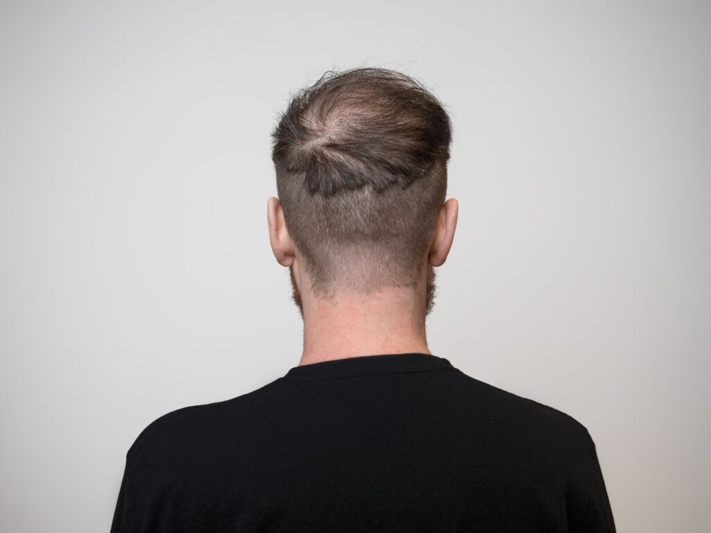 Young man facing away with the back of his head showing a bald patch.