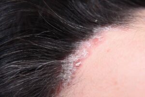 Psoriasis cuir chevelu