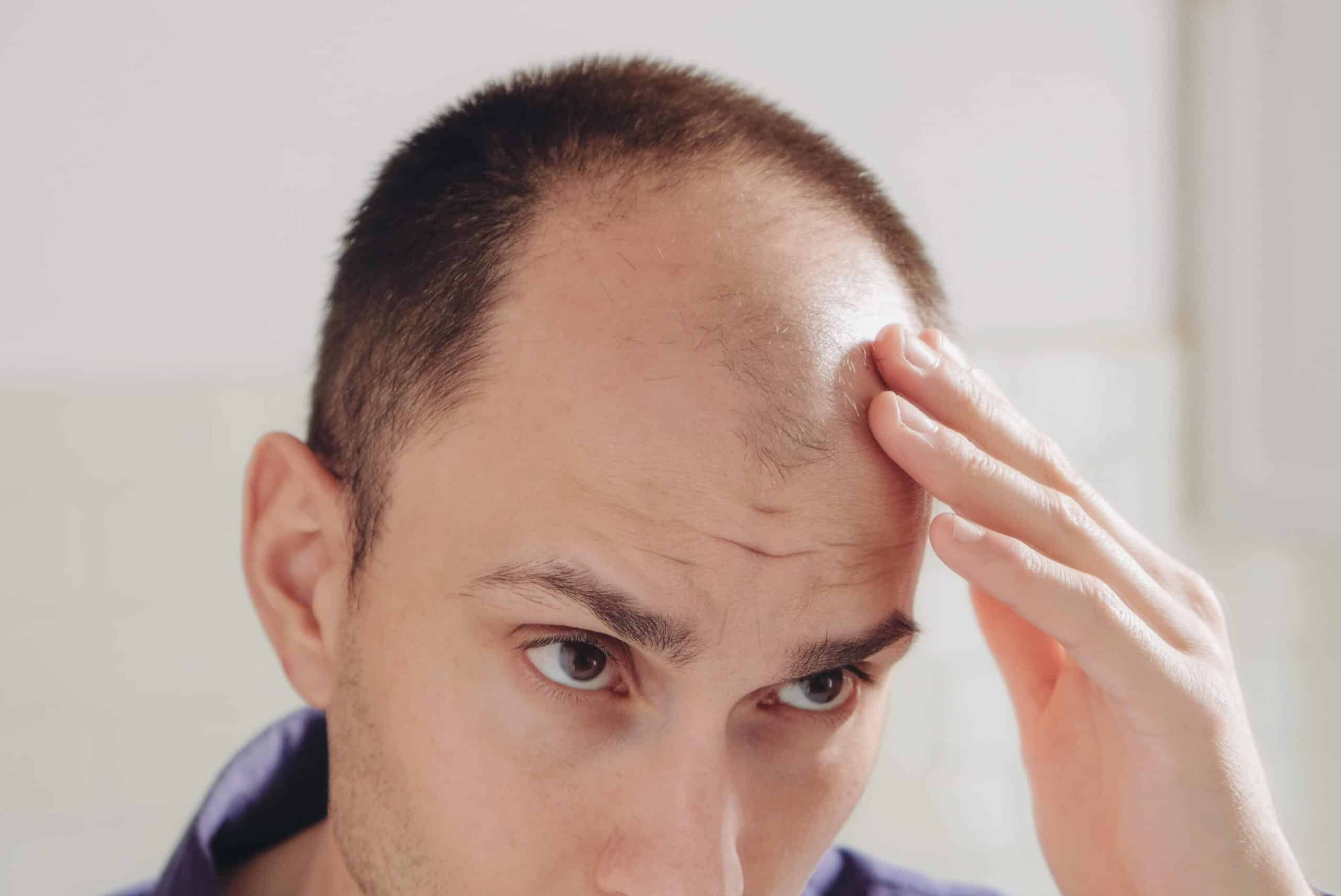 Man looking at mirror worried about hair loss.