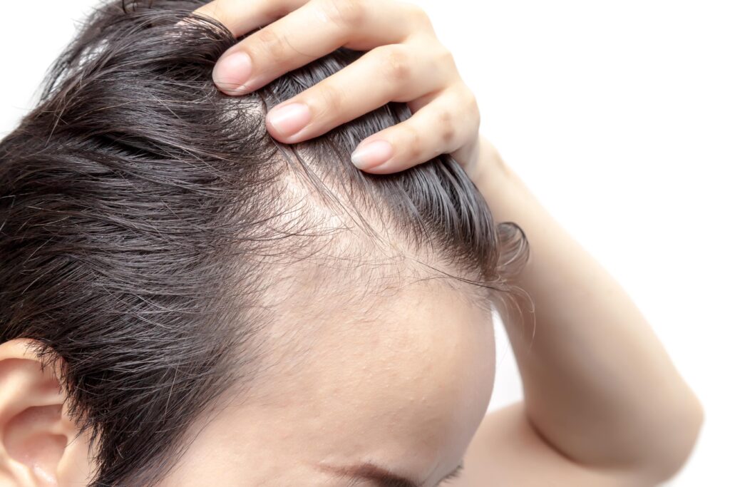 Un homme s'inquiète de sa chute de cheveux