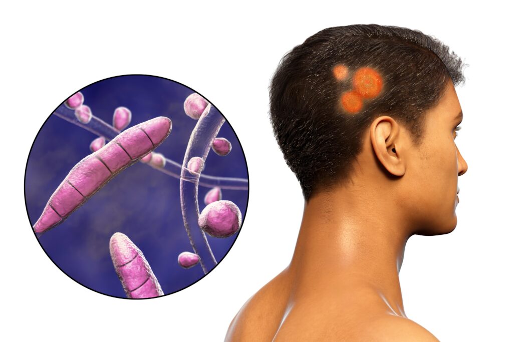 Fungal infection on a man's head, 3D illustration