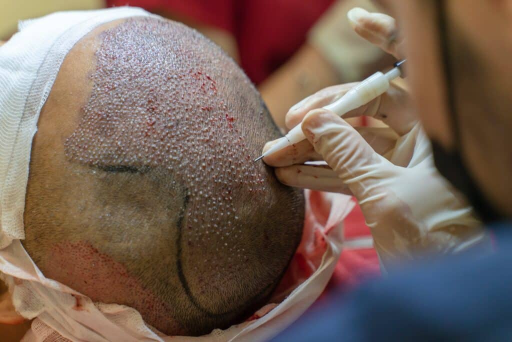 DHI Hair Transplant