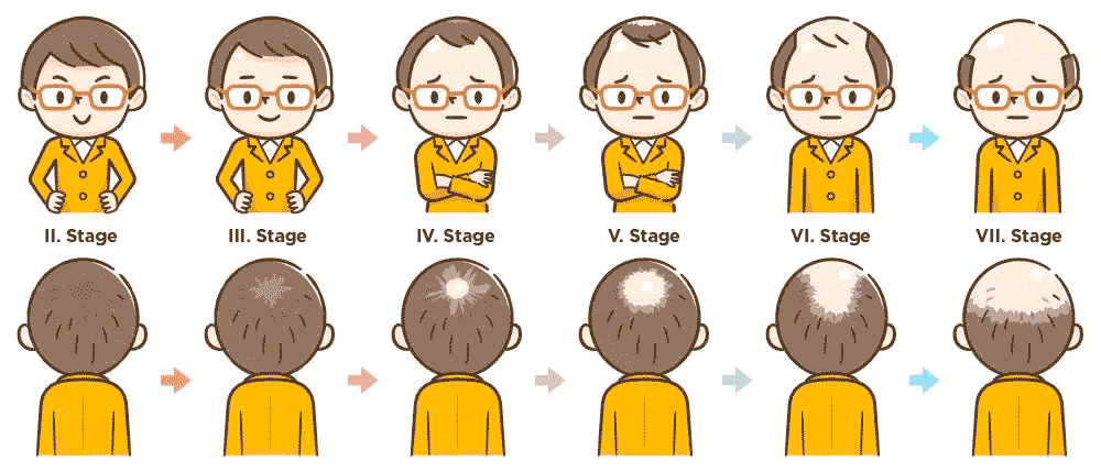 hair loss can be divided in 6 stages