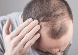 Minoxidil et chute de cheveux