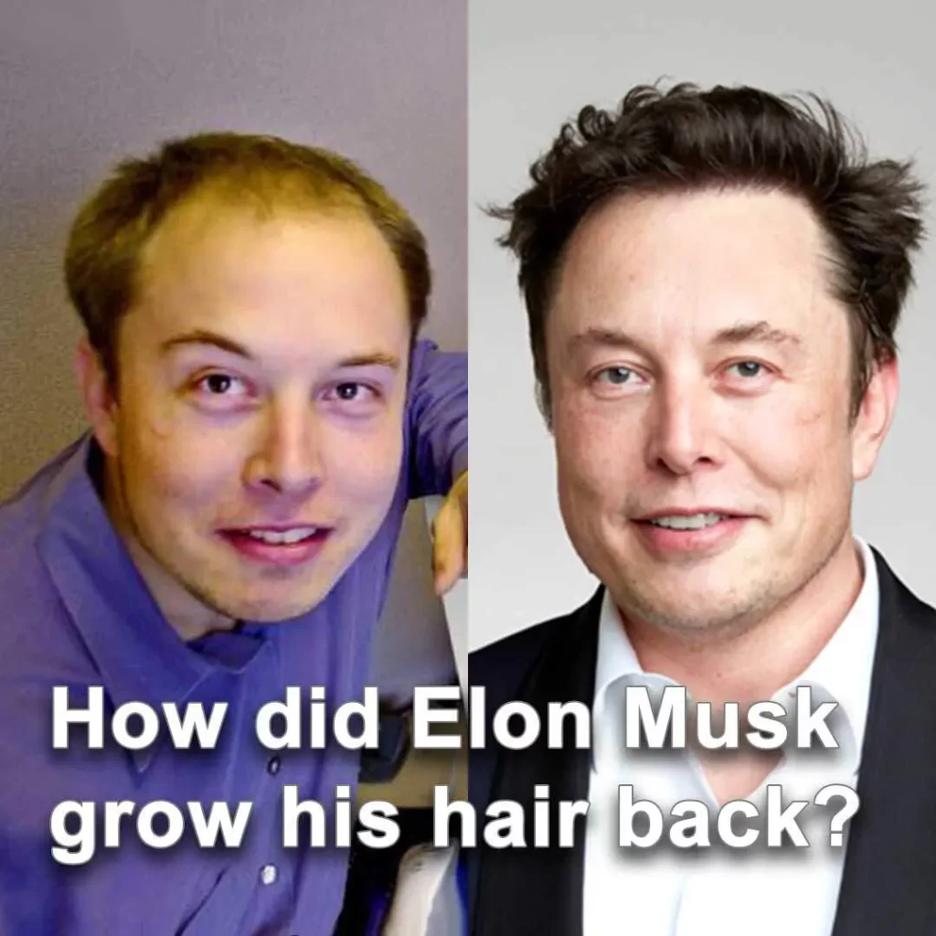 elon-musk-trapianto-di-capelli-prima-e-dopo-cosmedica