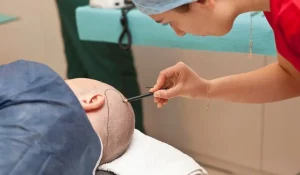 Medical tourism hair transplant in Turkey