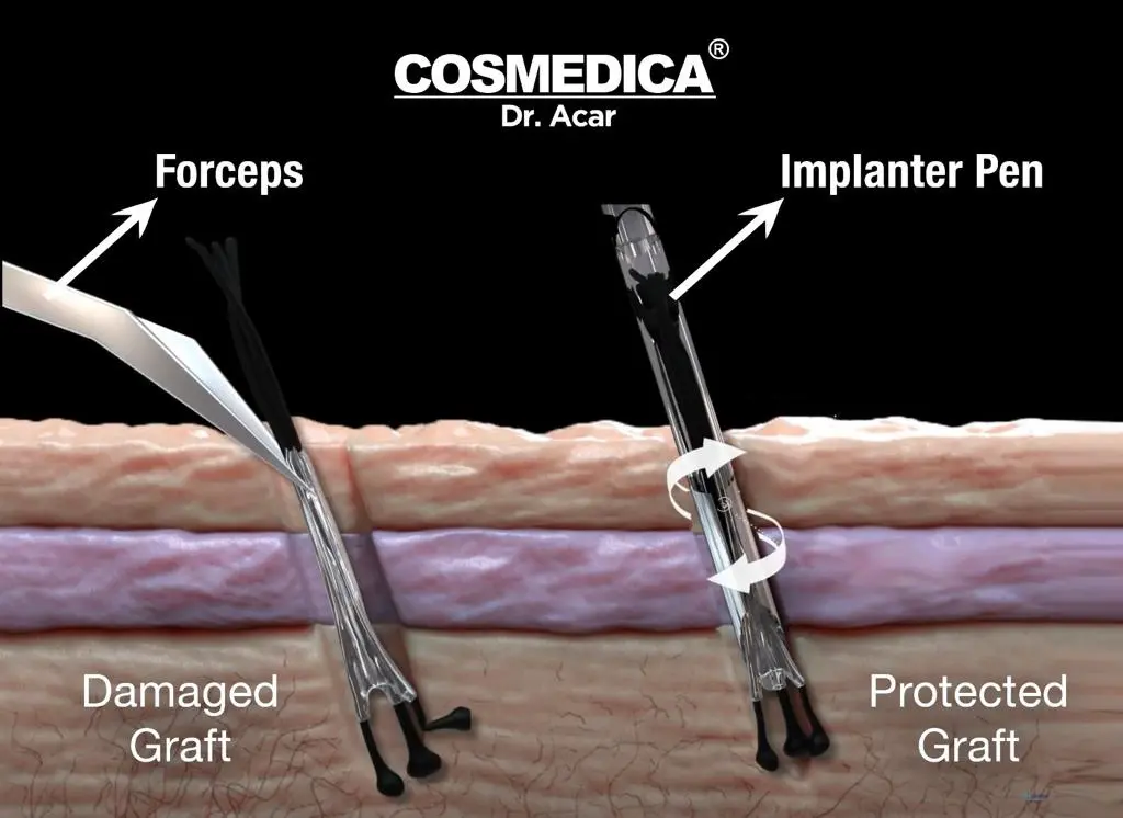 Trapianto capelli Turchia - sistema impiantare